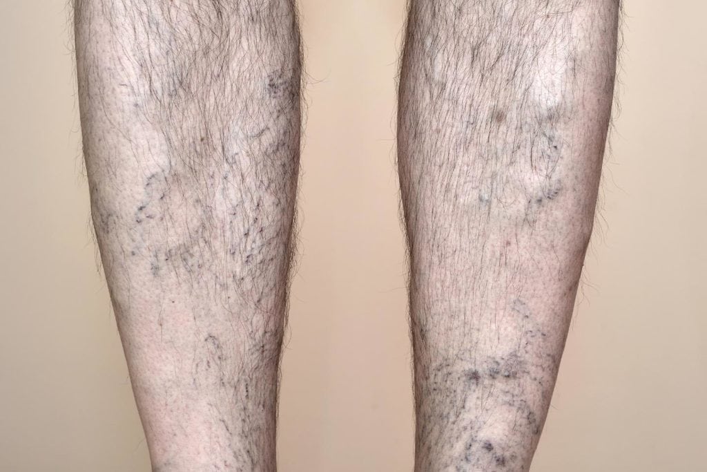 man's legs with varicose veins