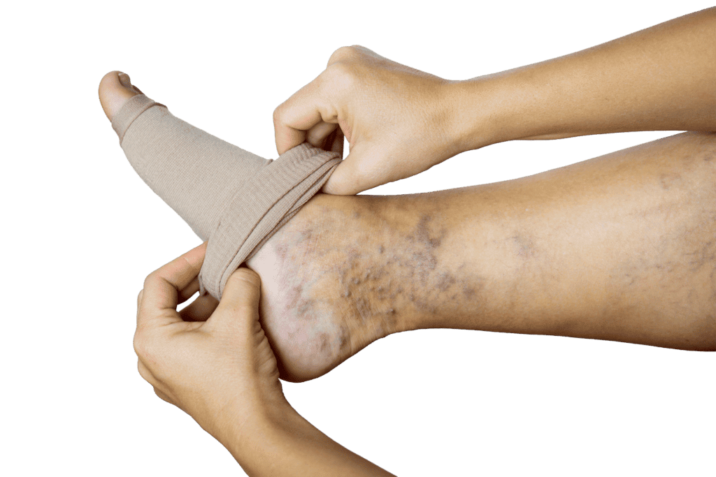 person putting on a compression stocking to prevent may-thurner syndrome