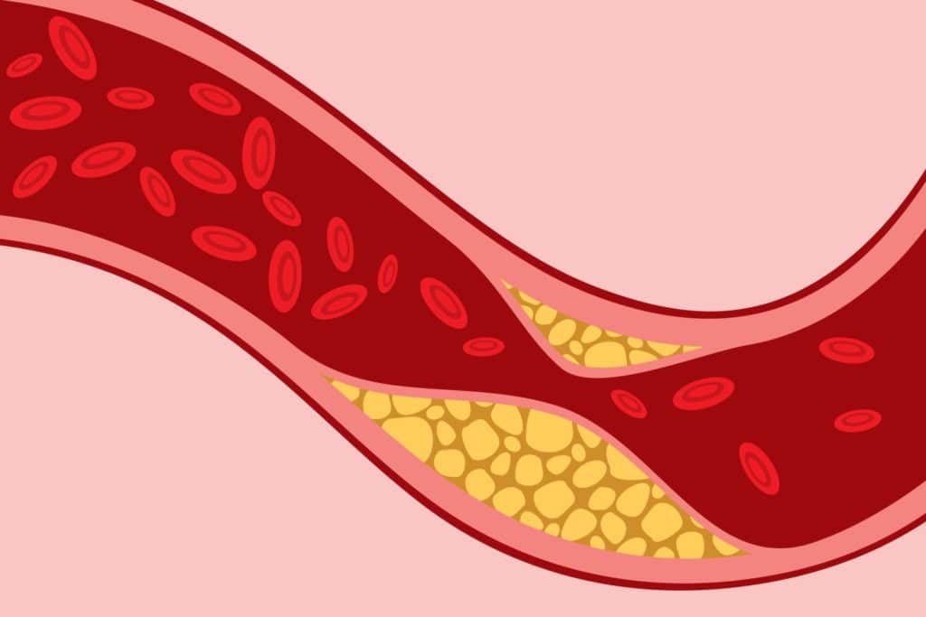 illustration of artery with plaque from post thrombotic syndrome