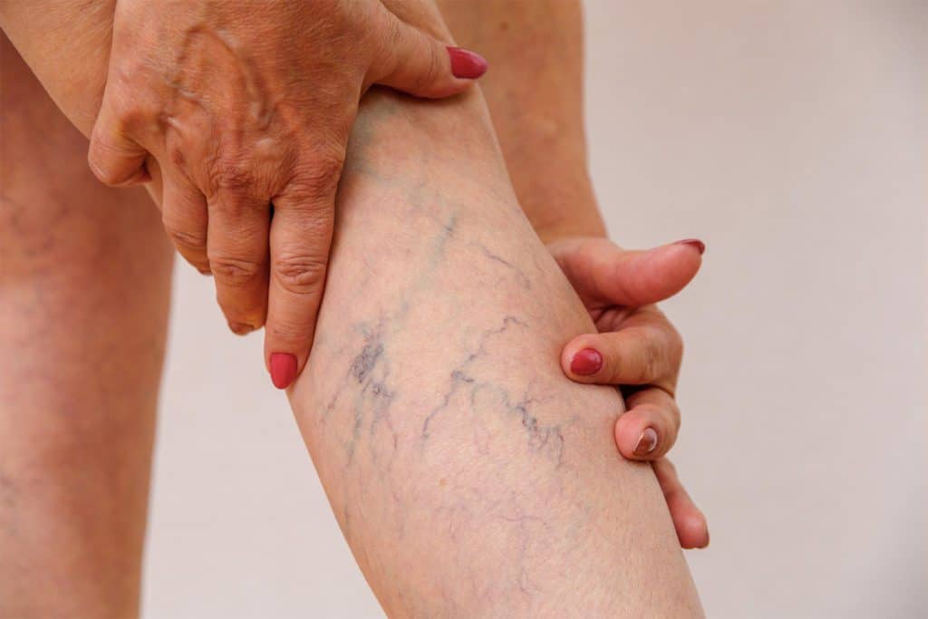 woman's leg with varicose veins from post thrombotic syndrome