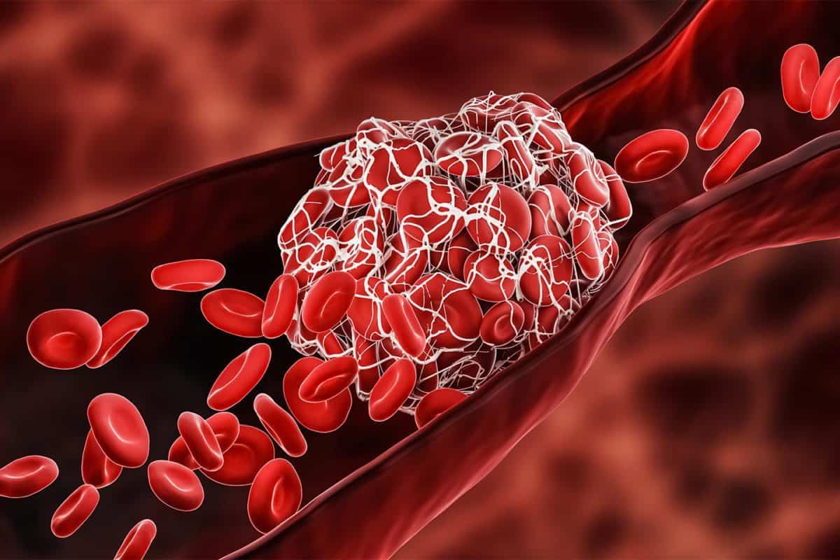 render of a Deep Vein Thrombosis blood clot
