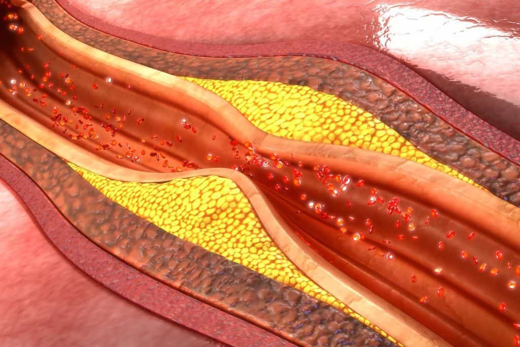 illustration of plaque in arteries