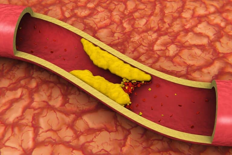 Clogged Artery causing Critical Limb Ischemia