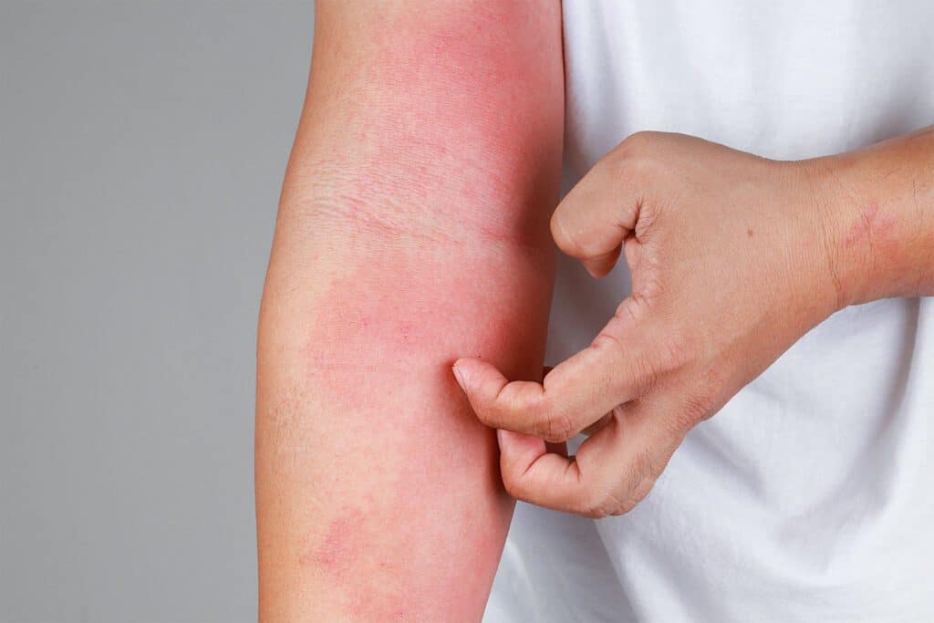 scratching arm with dermatitis rash