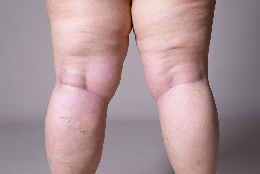 legs of a woman with Lymphedema