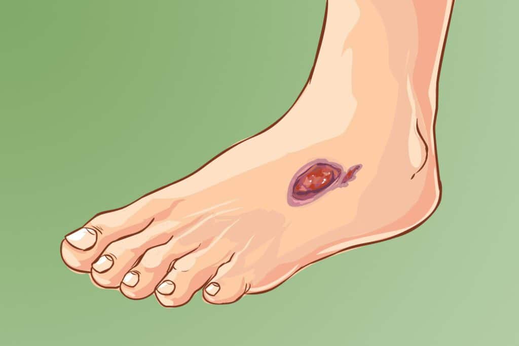 illustration of an ulcer on a foot
