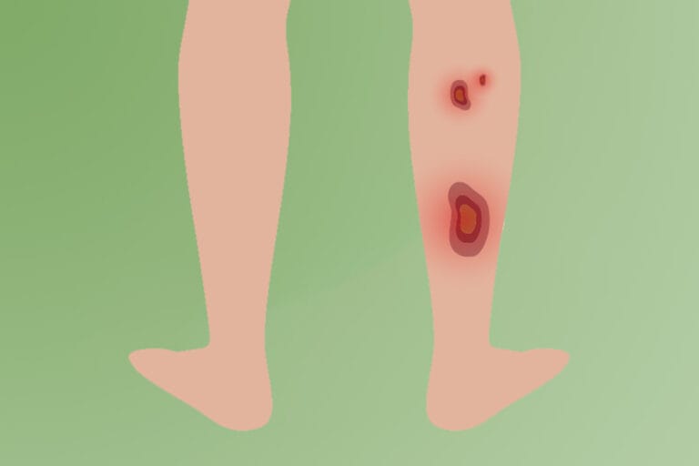 Illustration of legs with skin ulcers