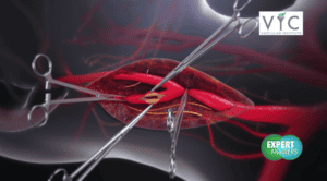 Animated graphic of the opining of an artery via surgery