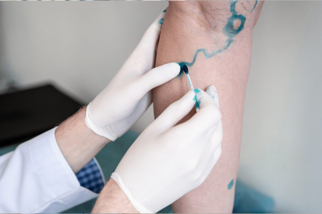 A medical professional in gloves applies blue dye to a patient's leg during a procedure.