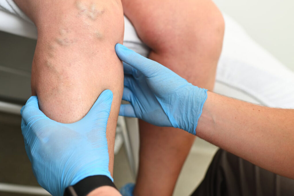A healthcare professional examines a patient's knee while wearing blue gloves, focusing on visible skin imperfections.