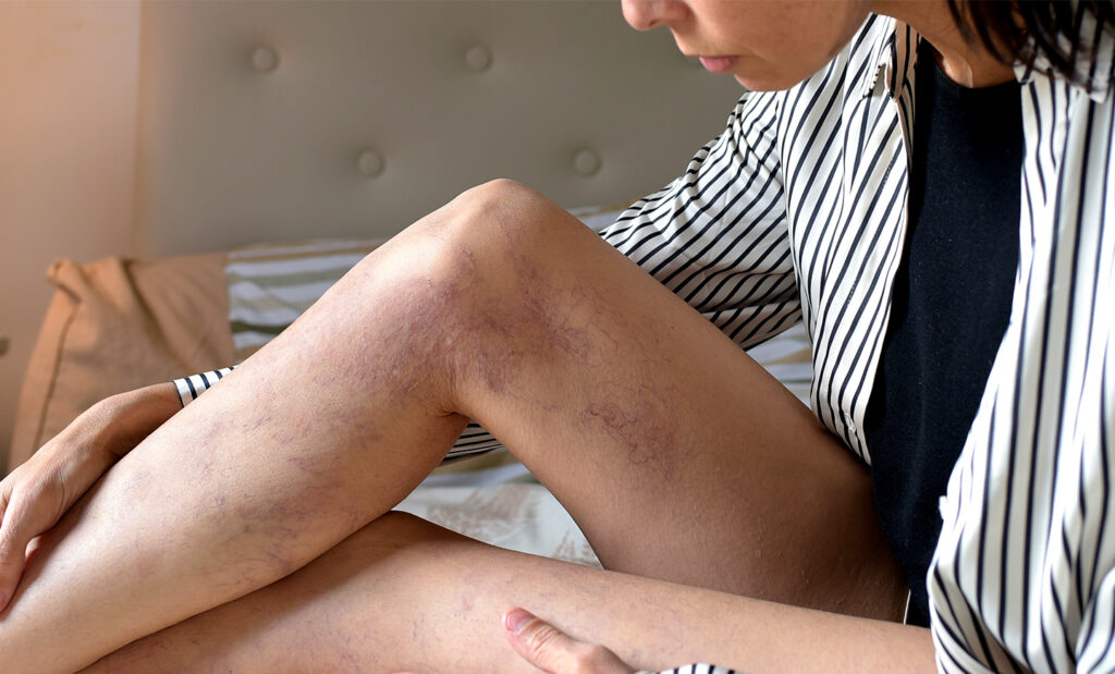 A person sitting on a bed, examining their bruised legs, wearing a striped shirt and showing a contemplative expression.