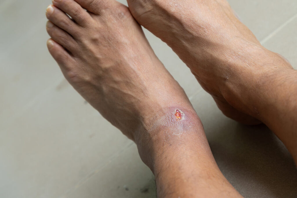 venous stasis ulcers on foot