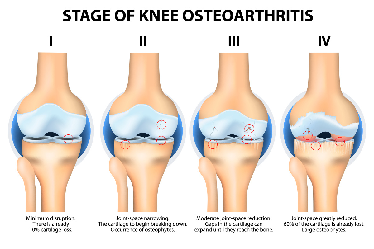 Diagram showing osteoarthritis development