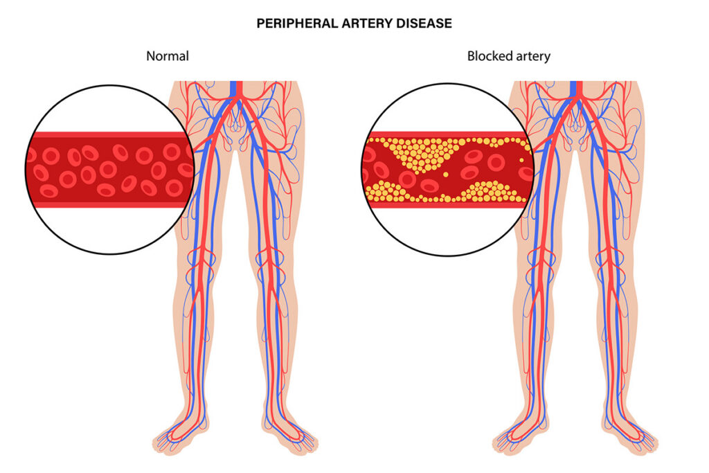 Peripheral Artery Disease