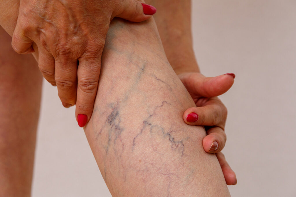 Varicose Veins