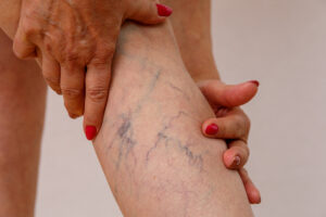 Varicose Veins