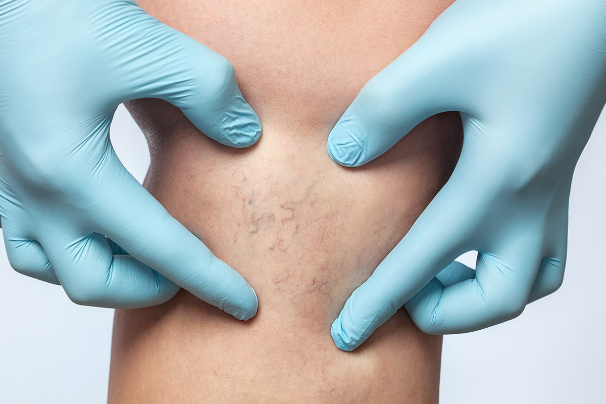 doctor inspecting veins on legs
