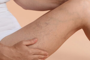 woman's leg with visible spider and vercose veins