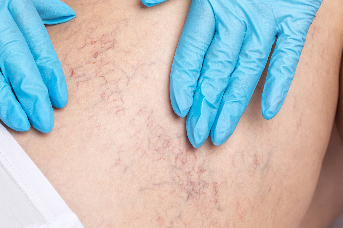 thigh with spider veins