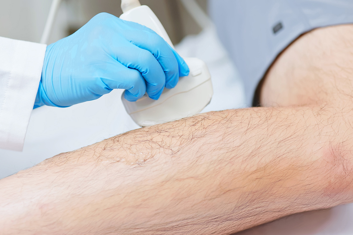 ultrasound therapy for veins on legs