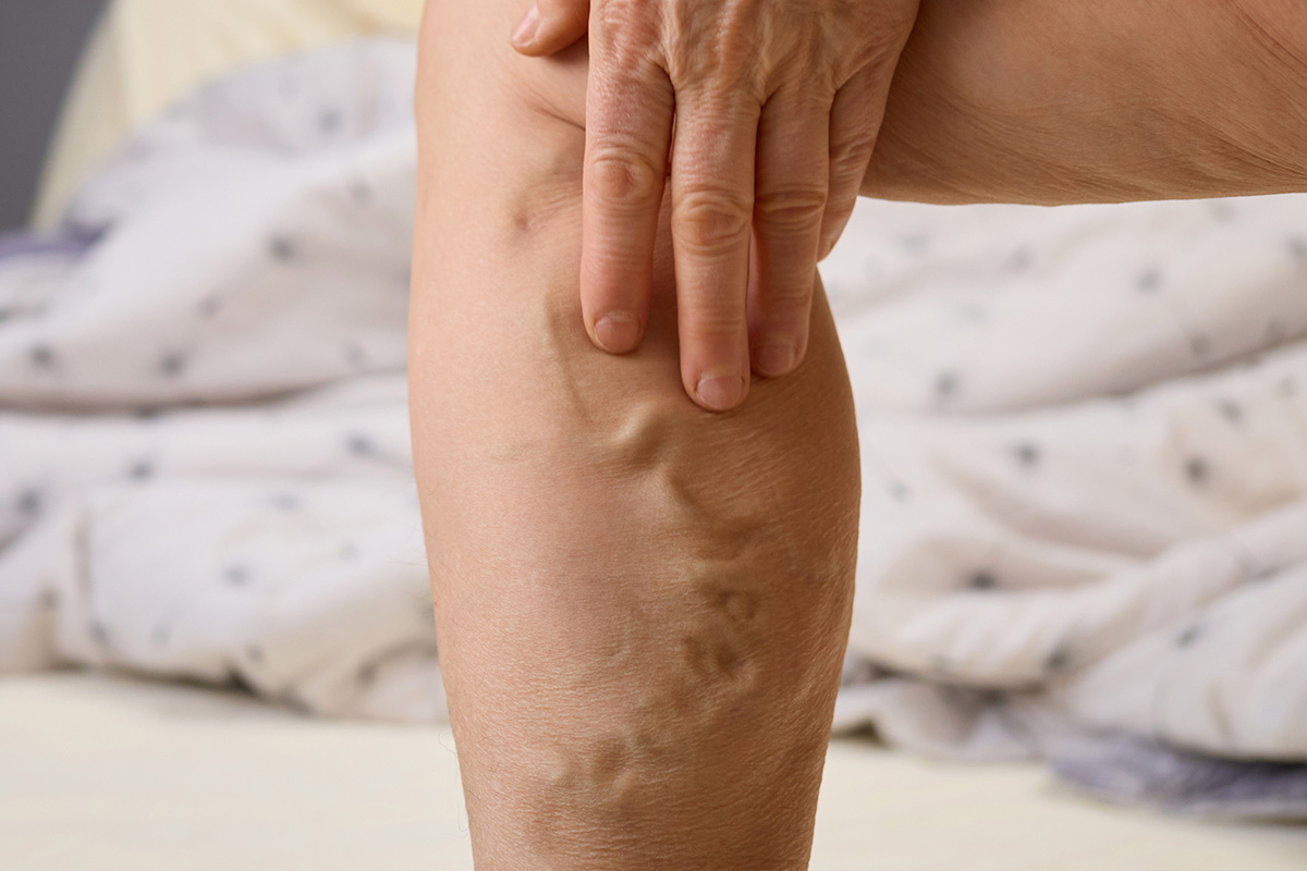 calf with vericose veins