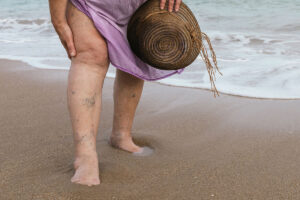 Varicose Veins on legs at the beach