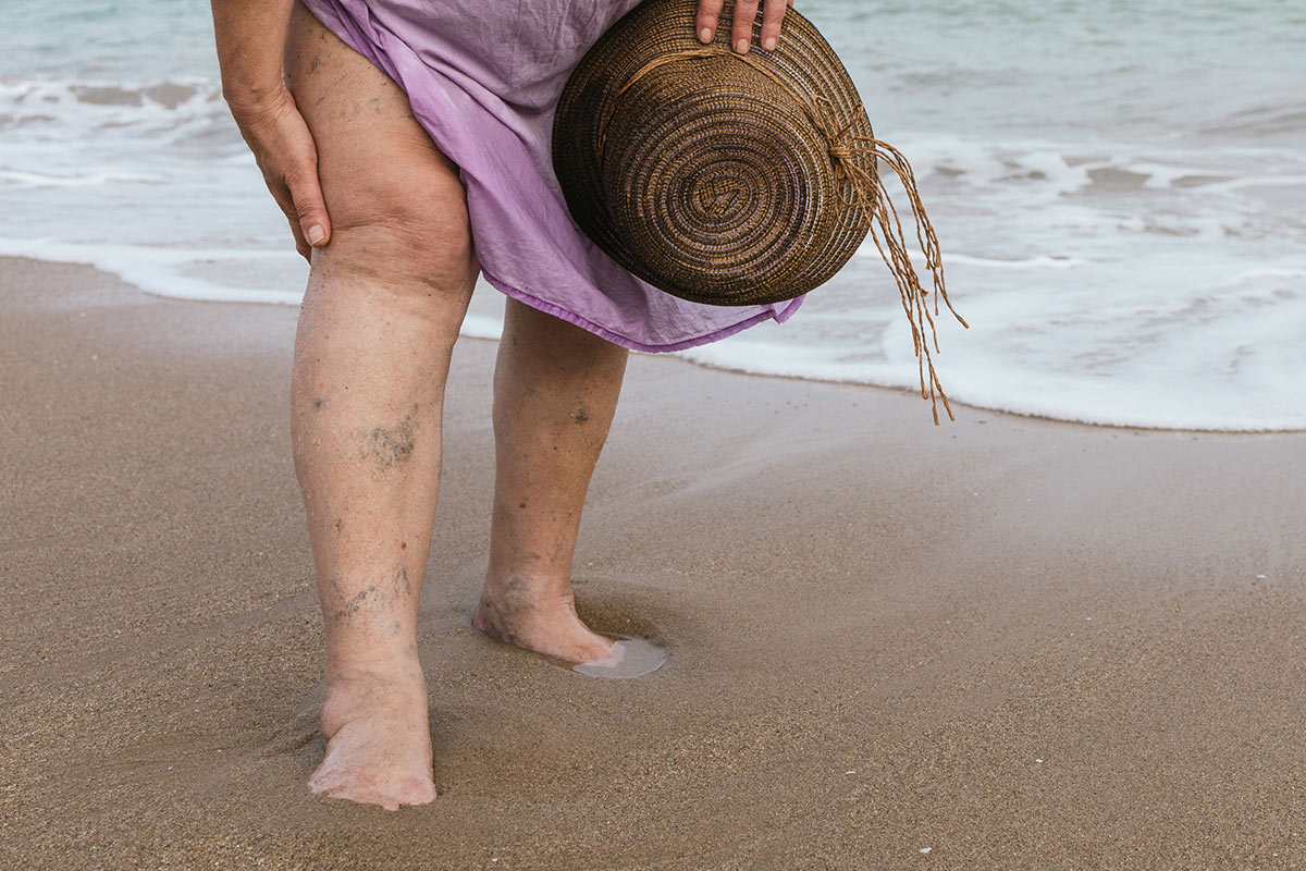 Varicose Veins on legs at the beach