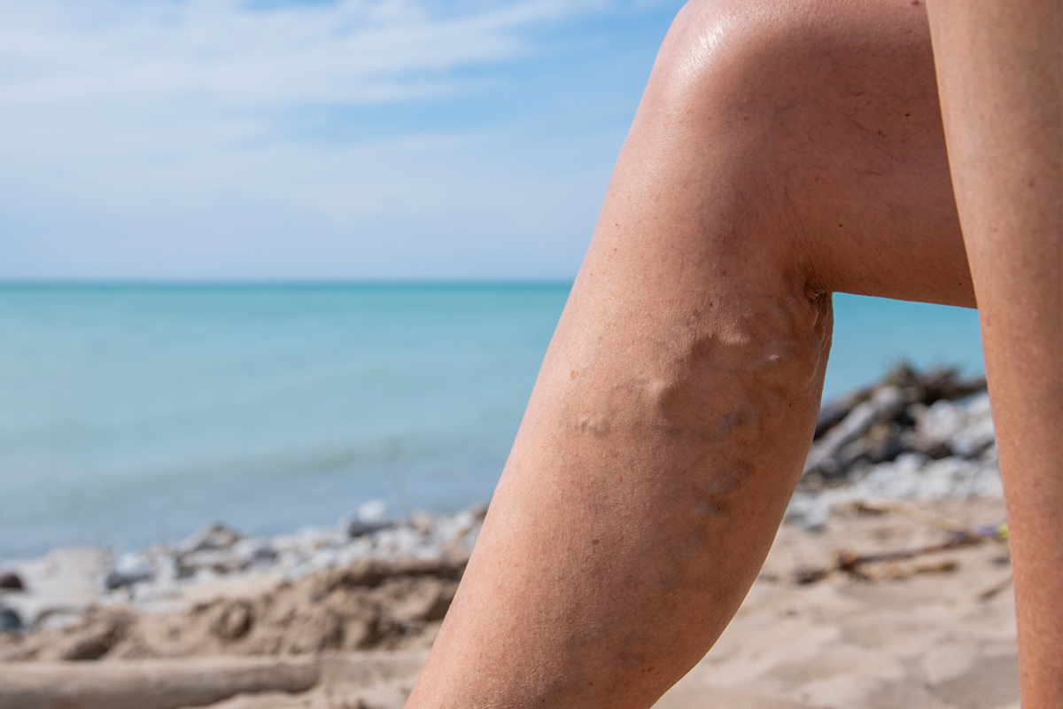 vericose veins on laegs at the beach