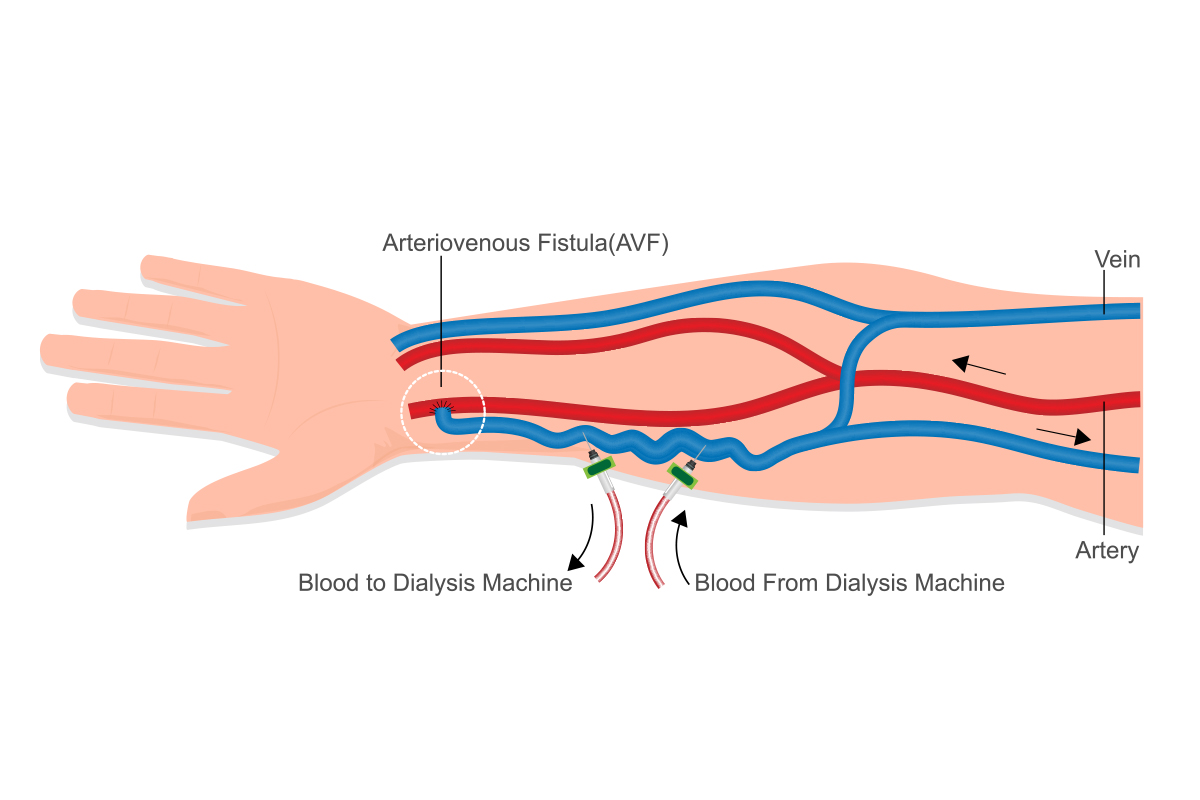 Fistula diagram of an arm