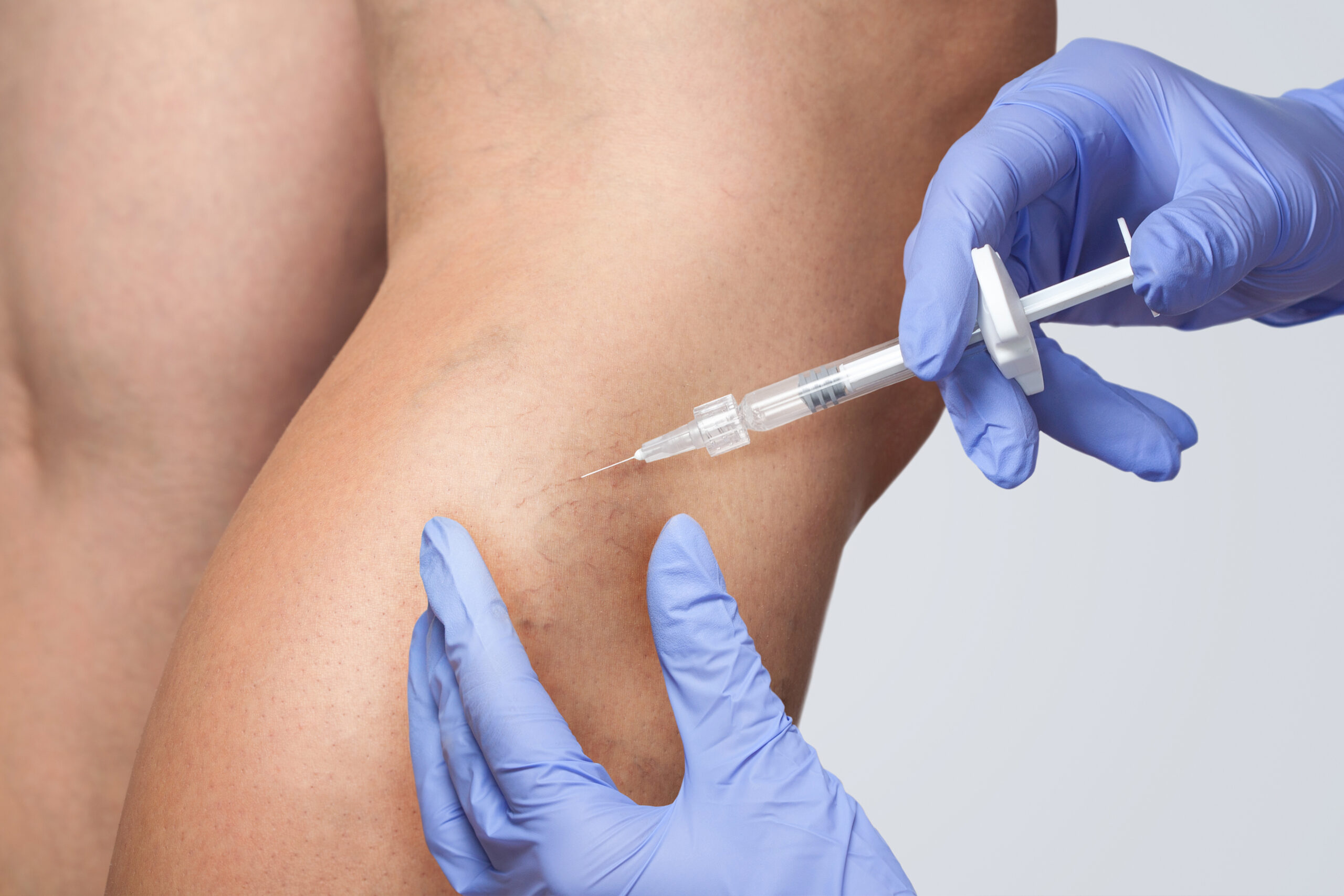 Sclerotherapy treatment with injection