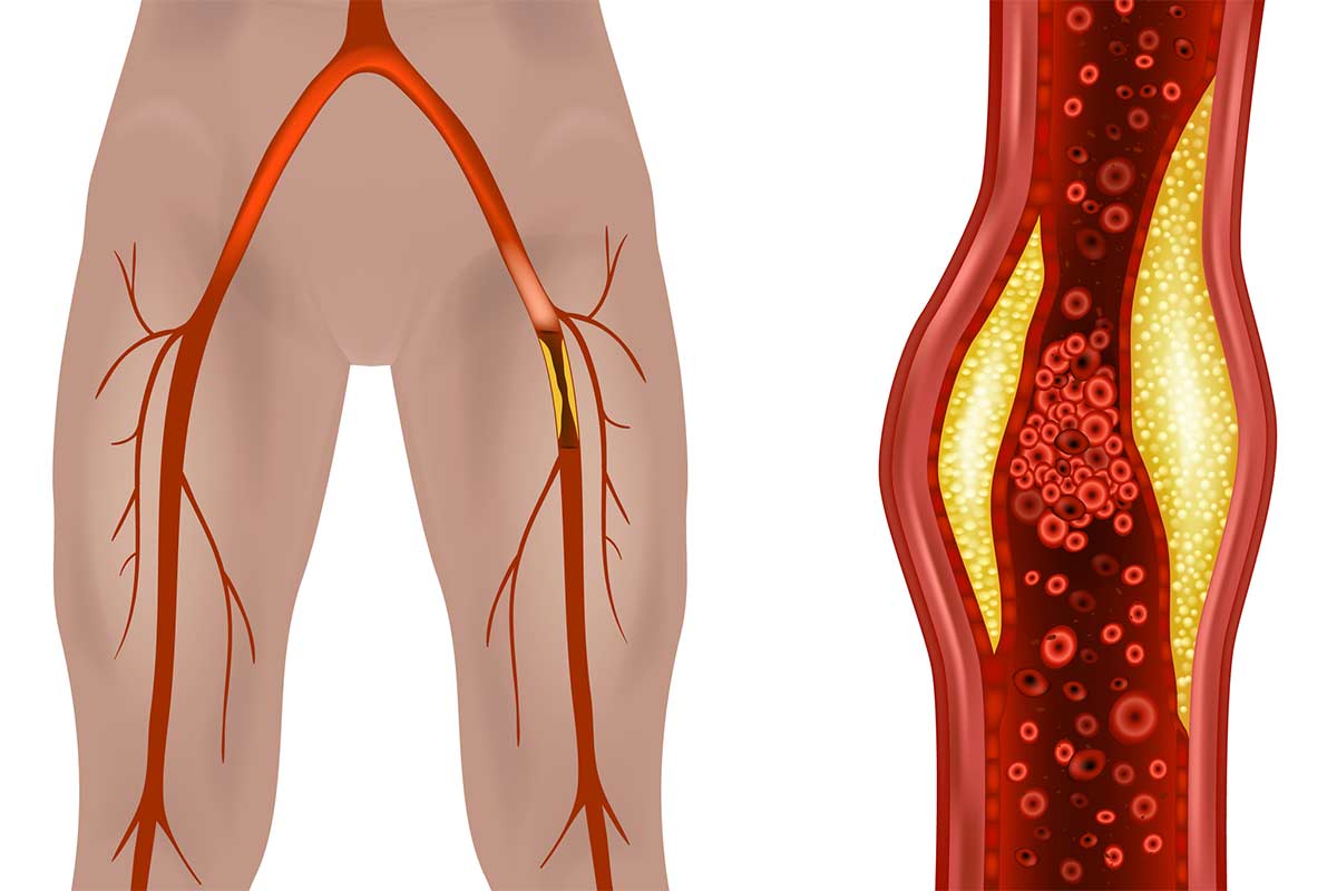 Internal look at vein blockage in the legs